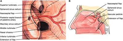 Methods of Skull Base Repair Following Endoscopic Endonasal Tumor Resection: A Review